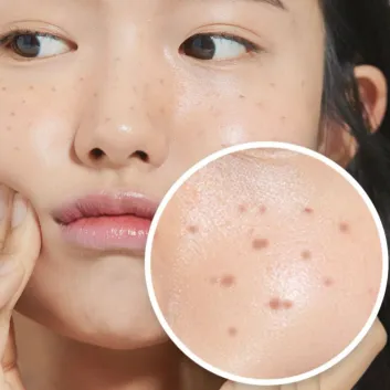 3D Skin Analysis & Consultation