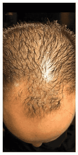 Before Treatment