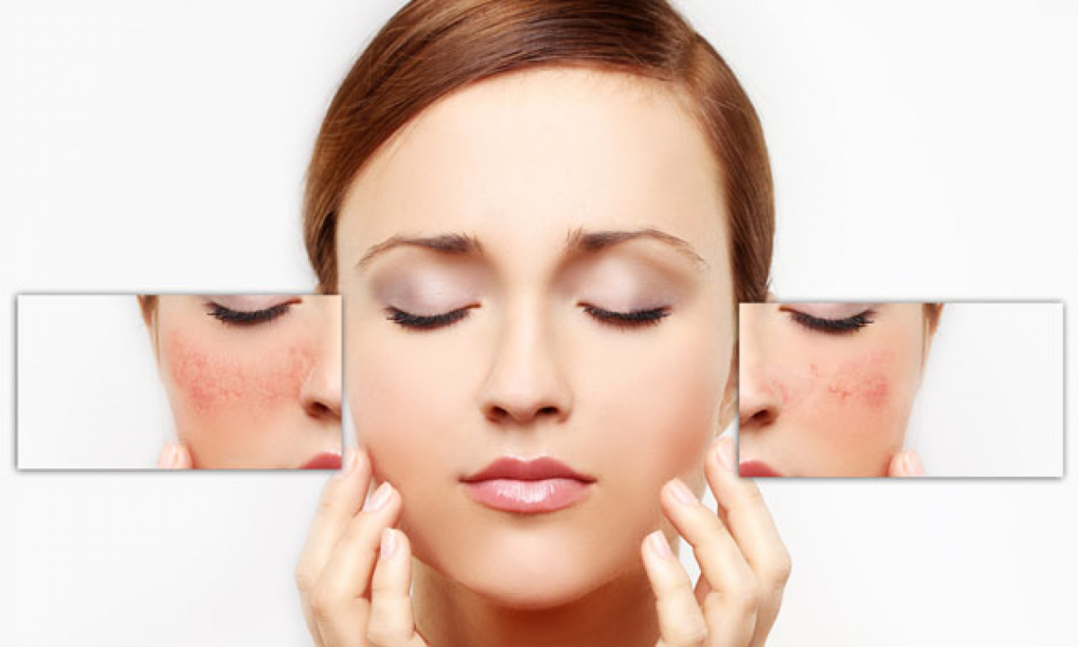 KorinMi Xylift Half Face Lifting