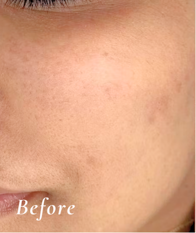 Before Treatment