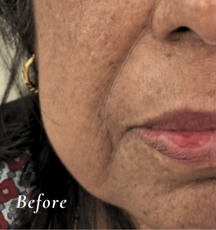 Before Treatment