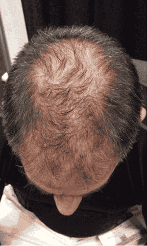 Before Treatment