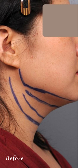 Before Treatment