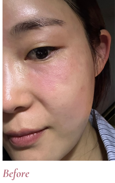 Before Treatment