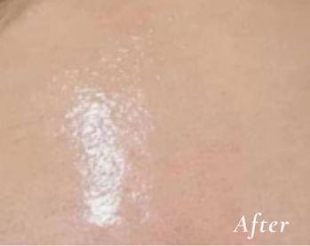 After Treatment
