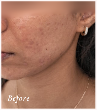 Before Treatment