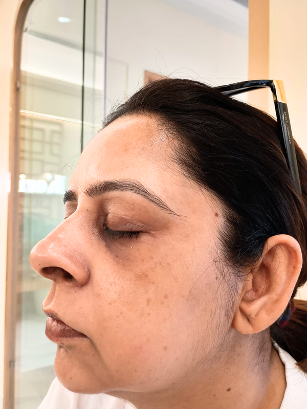 After Treatment