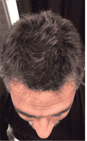 KorinMi Korean Scalp Detox Head Spa for Men