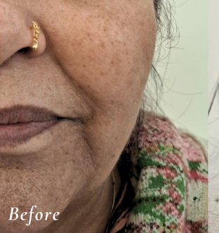 Before Treatment