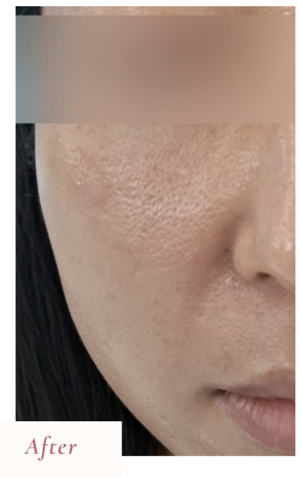 Before Treatment