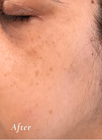 After Treatment