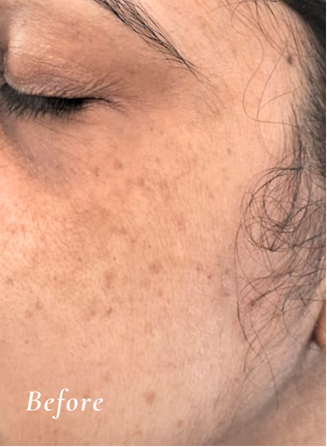 Before Treatment