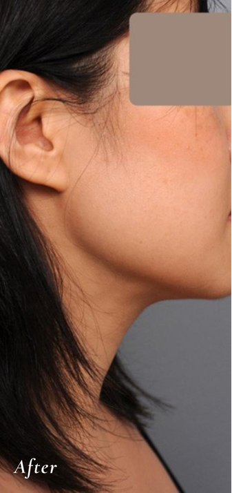 After Treatment