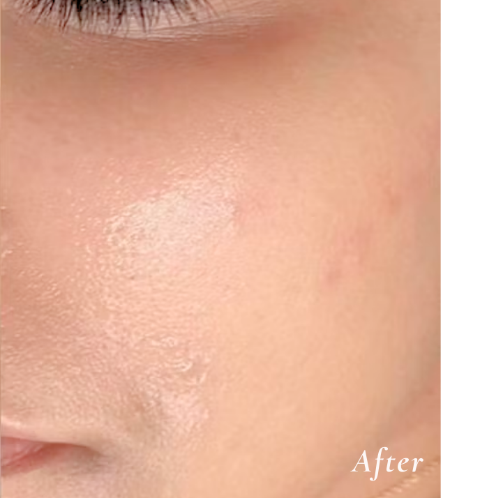 After Treatment
