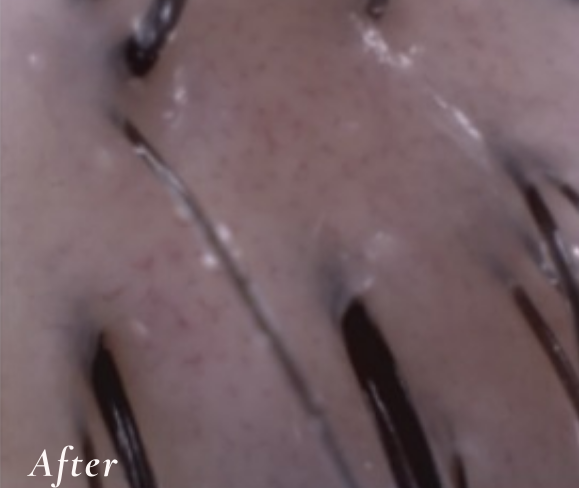 After Treatment