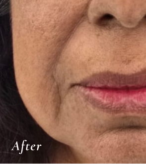 After Treatment