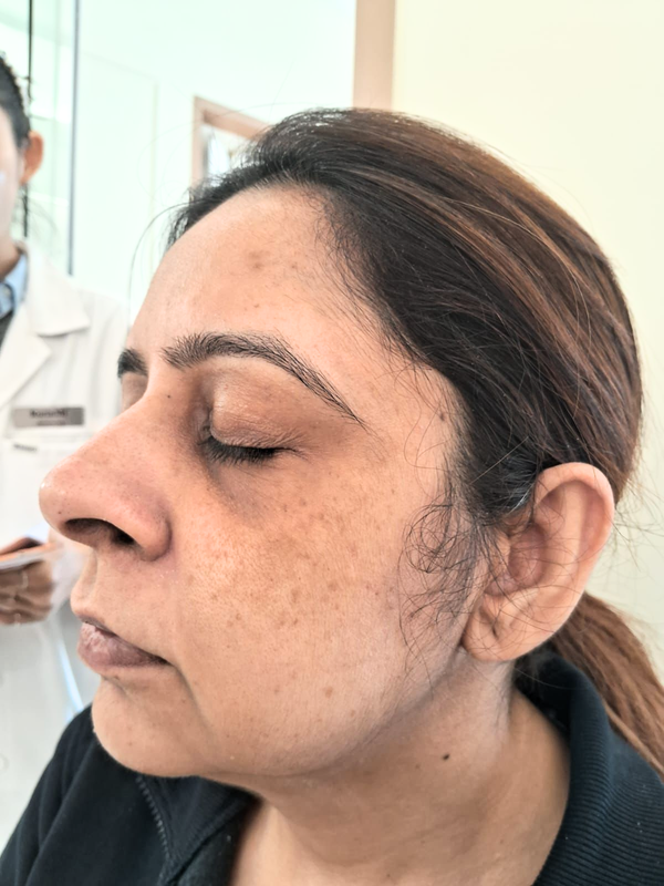 Before Treatment