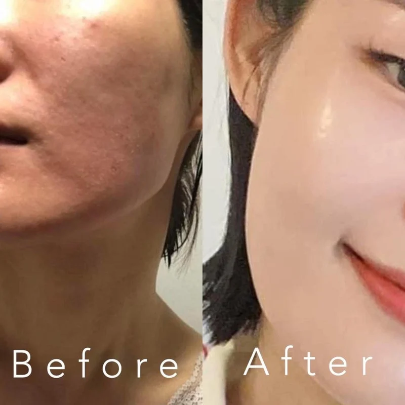 Before Treatment