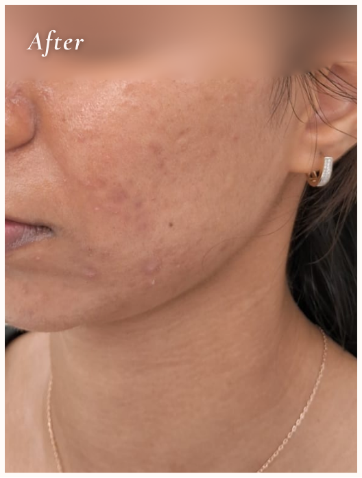 After Treatment