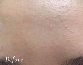 Before Treatment