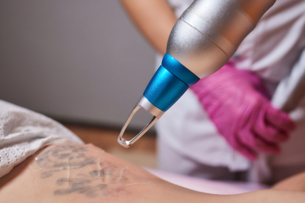 Luminex Tattoo Removal | Advanced Korean Pigment Reduction